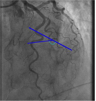 Relation Between Coronary Tortuosity and Vasomotor Dysfunction in Patients Without Obstructed Coronaries?